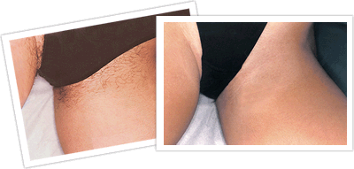 Natural Hair Removal Cream For Sensitive Skin Natural Hair Removal Cream For Sensitive Skin
