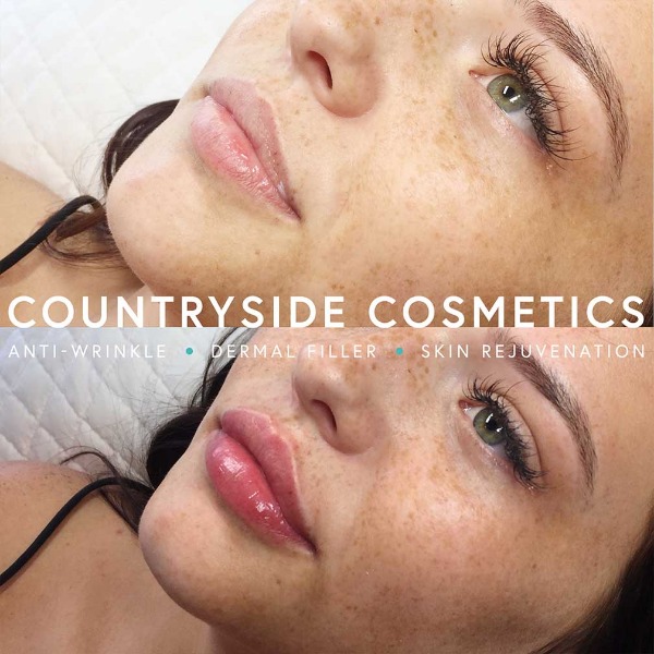 Natural lip enhancements performed at Countryside Cosmetics