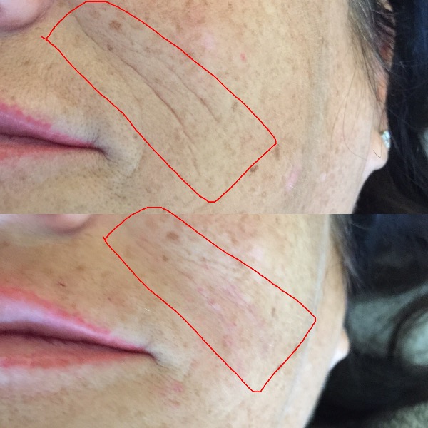 Skin Booster for fine lines