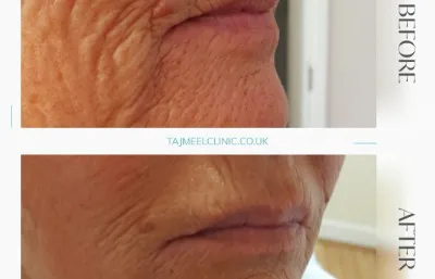 Before and after dermal filler treatment