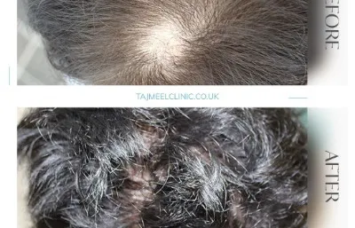Before and after FUE hair transplant treatment