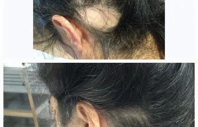 Before and after Hair loss treatment
