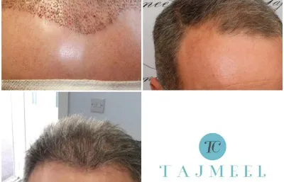 Before and after Hair rejuvenation treatment