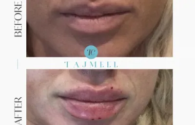 Before and after lip filler treatment