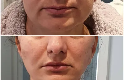 Before and after PDO thread lift