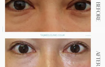 Before and after tear trough treatment
