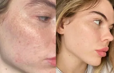 skin rejuvenation treatment Before and after