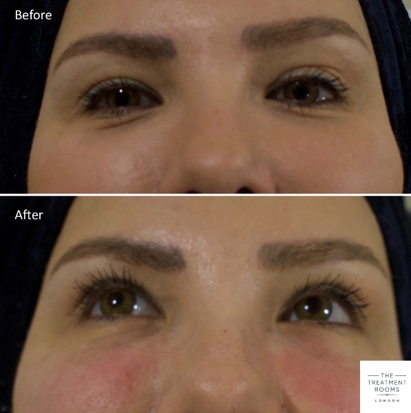 Tear Trough Fillers