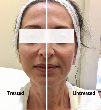 Face Thread Lift