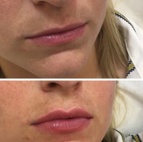 Lip Volumising and Contouring