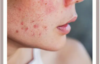 Acne treatment
