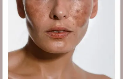 Hyperpigmentation
