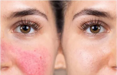 Rosacea