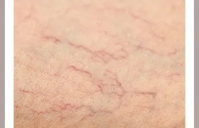 Thread vein treatment