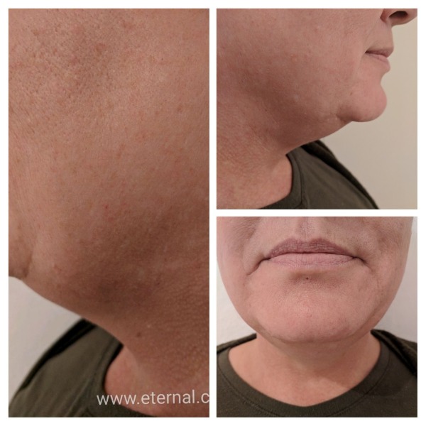 Double chin reduction and fat melting using laser