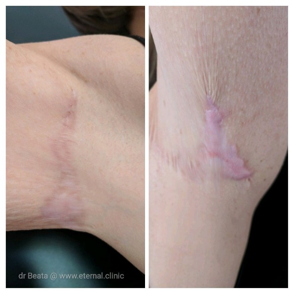 Post surgery scars Photo