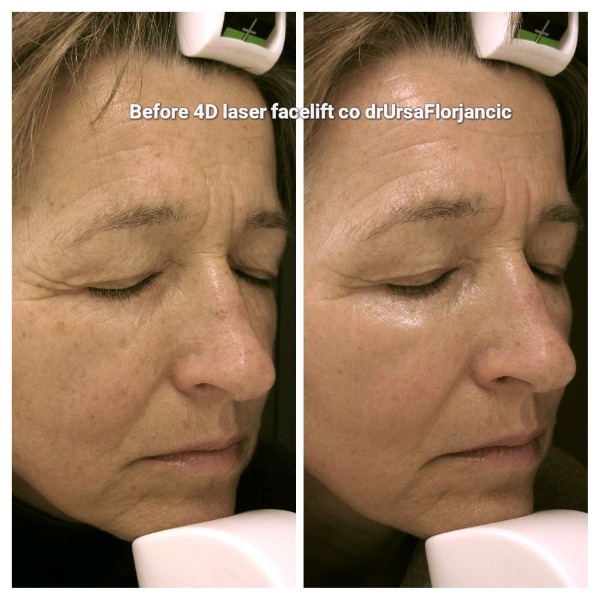 4d facelift near me