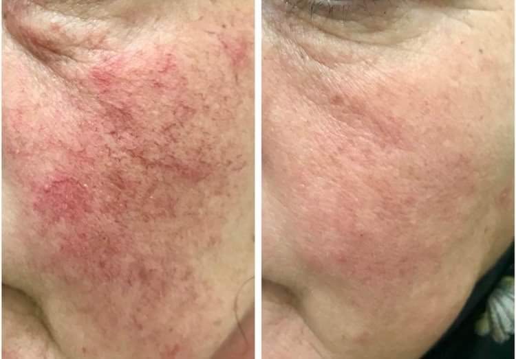 Teleangiectasia in rosacea  Photo