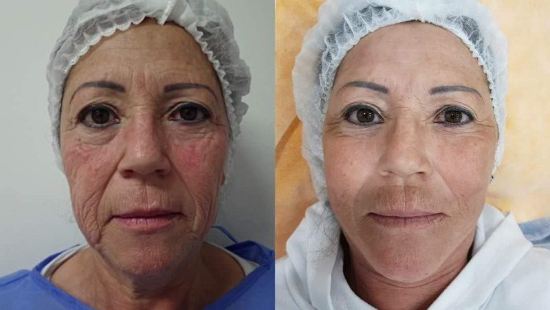 4D laser facelift  Photo