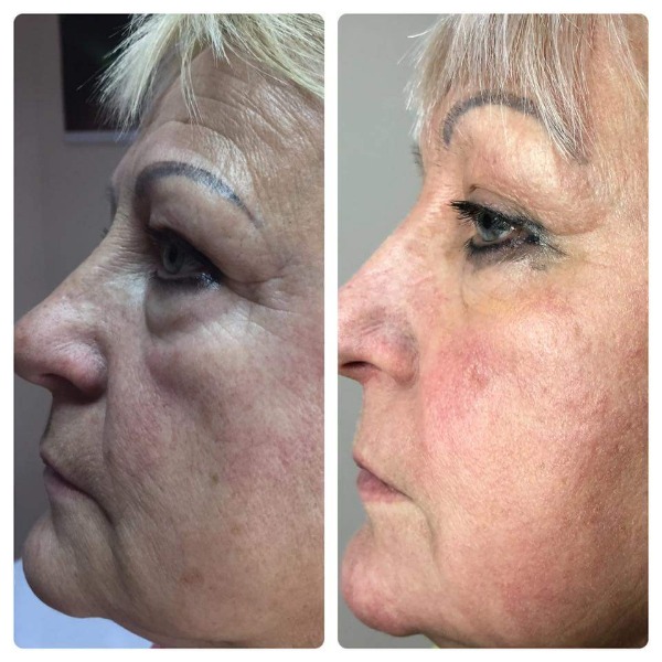 Laser skin tightening  Photo