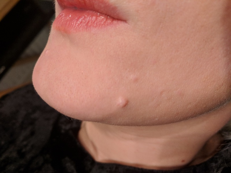 Mole removal