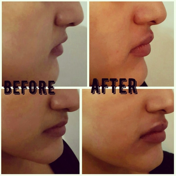 Lip Filler