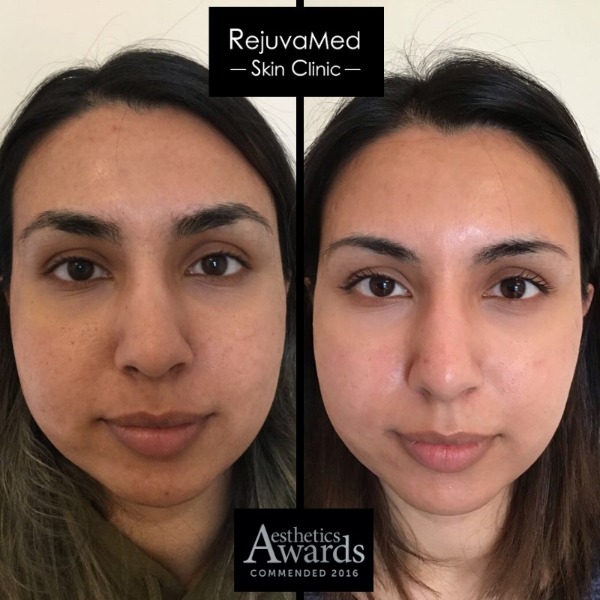 C02 Skin Resurfacing