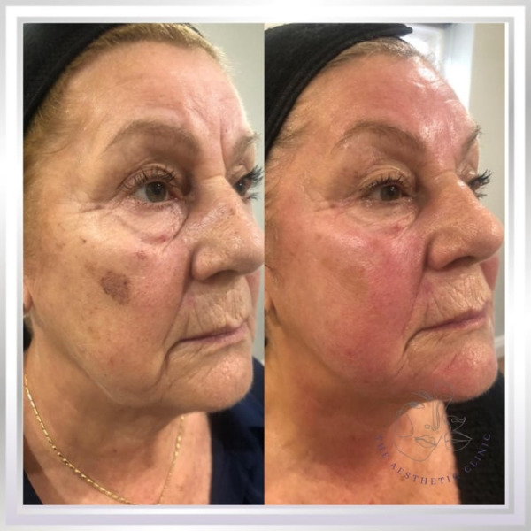 Skin Rejuvenation