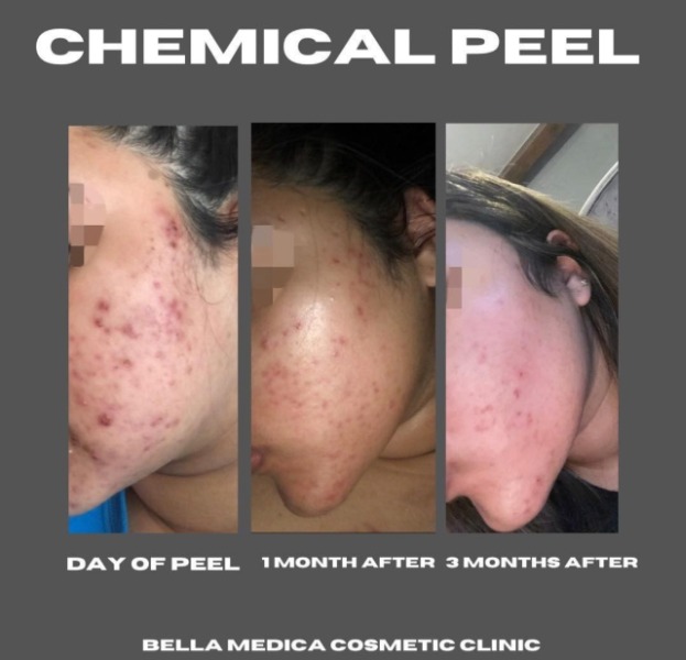 Chemical Peel to reduce Acne Scarring 