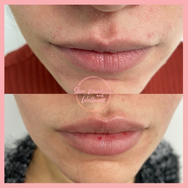 Lip filler Photo