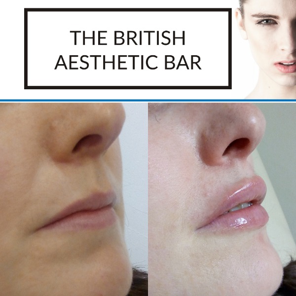 Juvederm