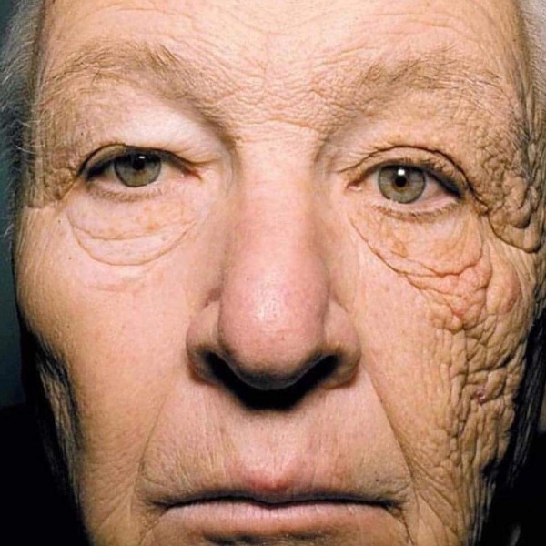 Sun damage to skin