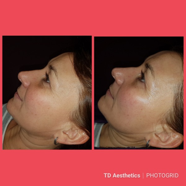 Skin peel with natural glow