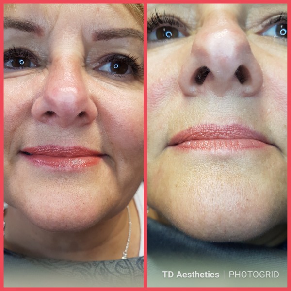 Dermal filler treatment for nose to mouth lines Photo