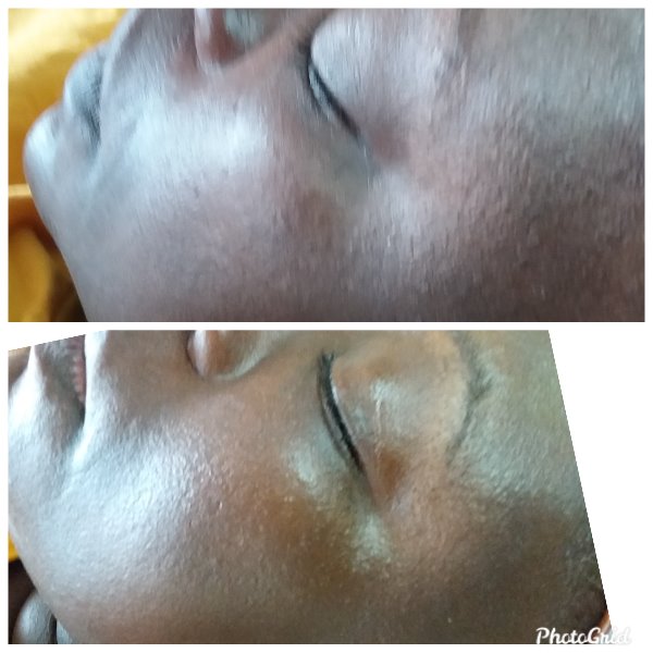 Before and After Dermaplaning