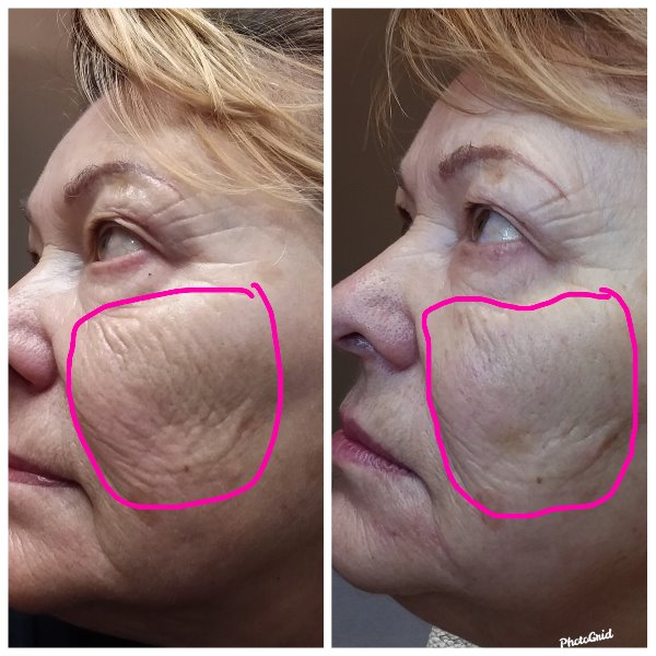 Before and After Sunekos treatment