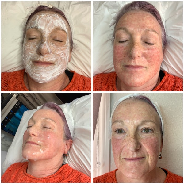 Before, during and after Medical needling treatment