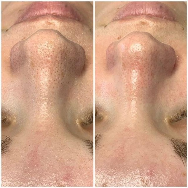 Before and straight after 1 HydraFacial