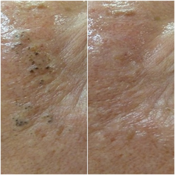 Before and straight after 1 HydraFacial Photo