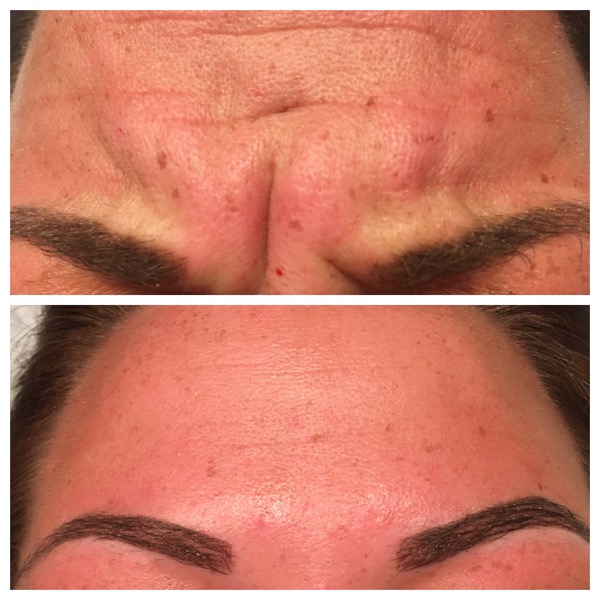 Wrinkle relaxing treatment between the brows