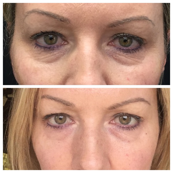 1ml Juvederm volbella Photo