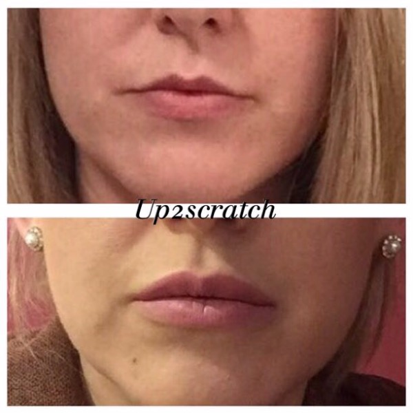 1ml lip filler Photo