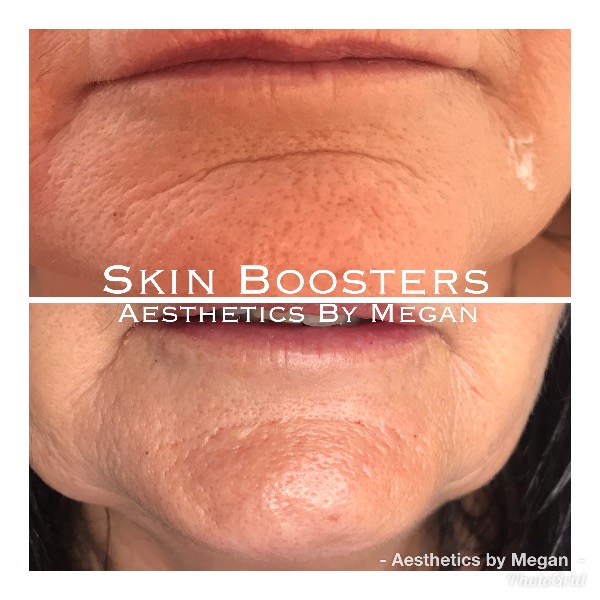 Skin Boosters