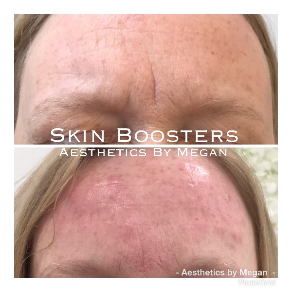 Skin Boosters Photo