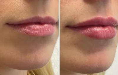 Before and after lip filler treatment