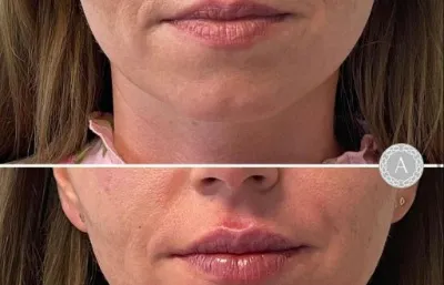 Before and after lip injection treatment