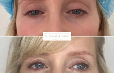 Before and after tear trough treatment