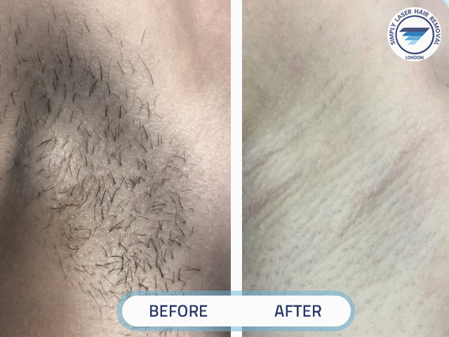 Woman under arms after 9 treatments