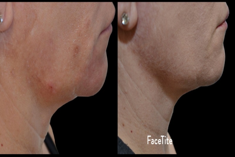 Radiofrequency For Facial Rejuvenation Information