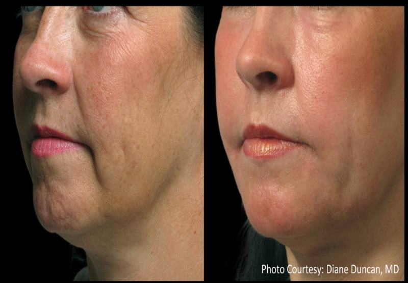 Radiofrequency For Facial Rejuvenation Information